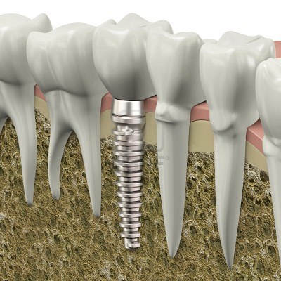 3d-rendering-of-a-dental-implant